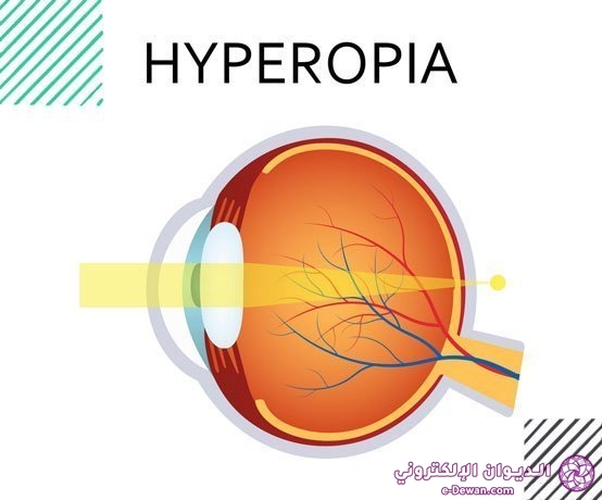 Long sight hyperopia