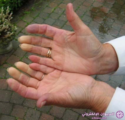 Hands Raynaud syndrome