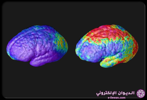 Schizophrenia s11 a neuroimaging photo 1