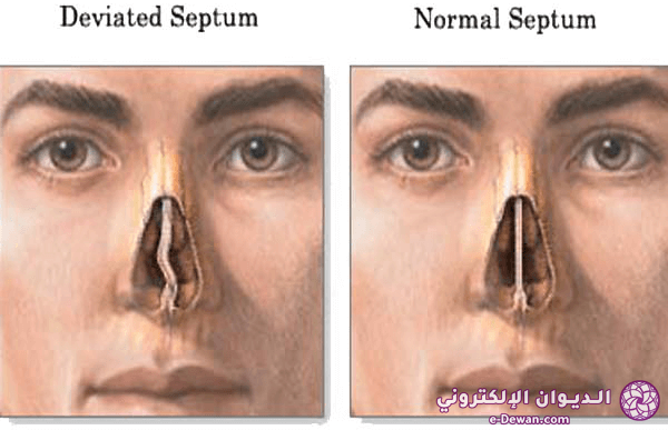 Deviated septum 1