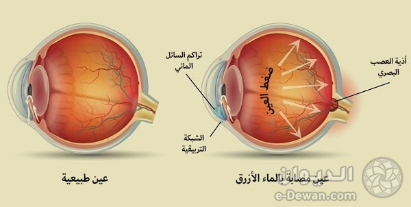 Glaucoma surgery