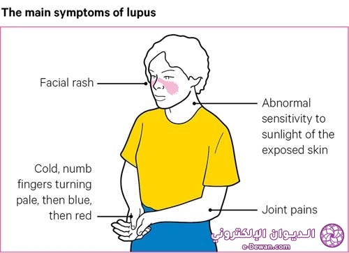 Lupus symptoms 500x363